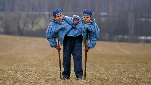 Самые известные сиамские близнецы СССР: жизнь и страдание 