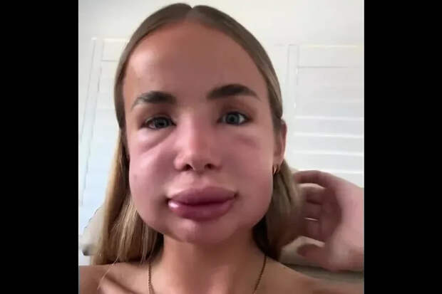 Лицо блогерши после удаления филлеров описали в сети фразой «собака съела пчелу»