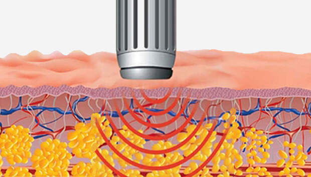 Противопоказания ударно-волновой терапии