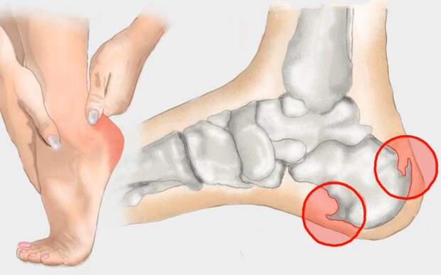 Пяточная шпора: лечение в Тюмени 