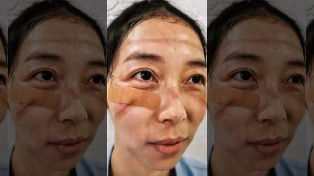 Китайские медики, лечащие пациентов с коронавирусом поделились фотографиями следов и ушибов оставленных на их лицах (ФОТО)