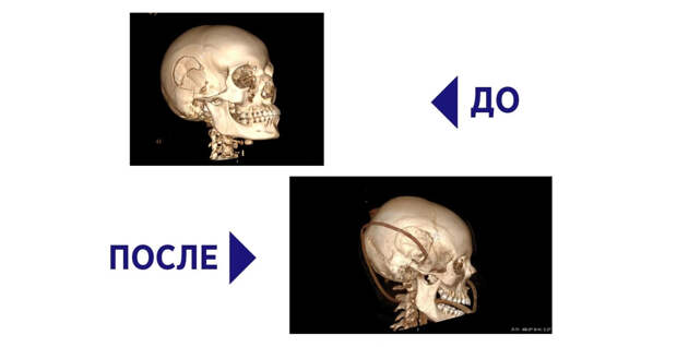 В Подмосковье нейрохирурги вытащили девушку с разбитым черепом с того света