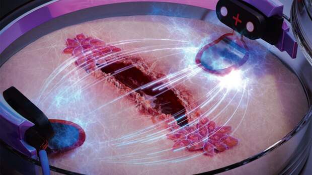 Заживает втрое быстрее: найден способ ускорить лечение ран с помощью электричества