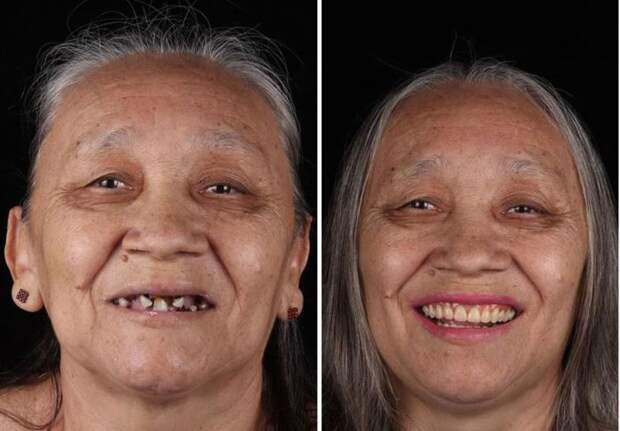 Женщина до посещения стоматолога и после.