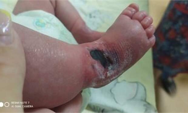 Новорожденный малыш получил травму ноги, находясь на лечении в больнице