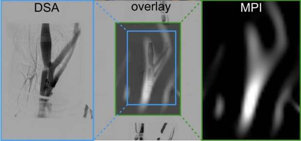 На человеке впервые опробовали магнитно-частичную томографию