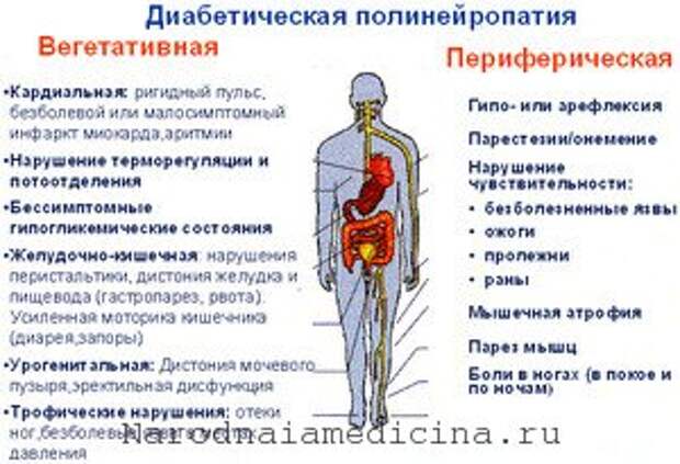 Диабетическая полинейропатия