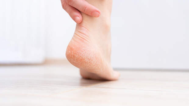 Почему появляются трещины на пятках, как от них избавиться и ухаживать за кожей стоп для профилактики