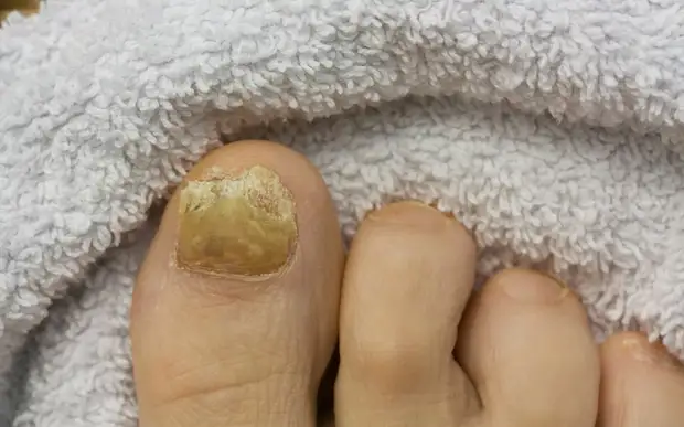 Микоз — грибковое поражение ногтей на пальцах ног