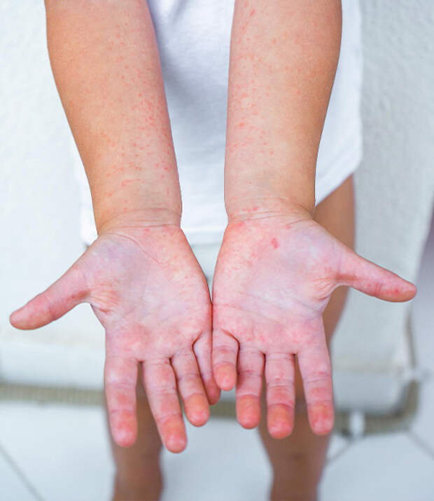 Вирус Коксаки: симптомы заболевания, лечение, осложнения