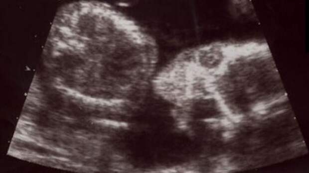Judge strikes down Iowa ‘fetal heartbeat’ abortion law