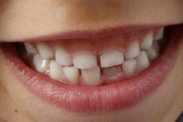 Проблемы с зубами гены, дети, родители