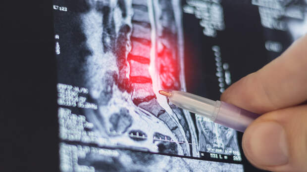 Нейрохирург Есин назвал межпозвонковую грыжу типичным осложнением остеохондроза