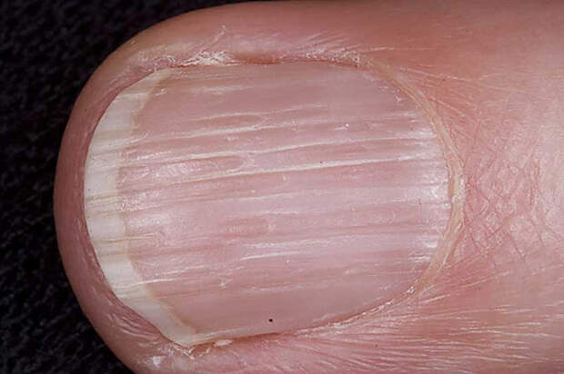 Поперечная бороздка на ногте (одна) болезнь, организм