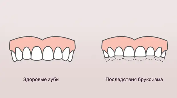Стискивание зубов — бруксизм
