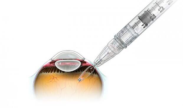 Новый глазной имплант позволит предотвратить старческую слепоту