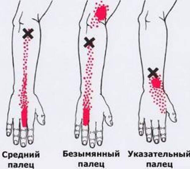 Триггерные точки карта отраженной боли