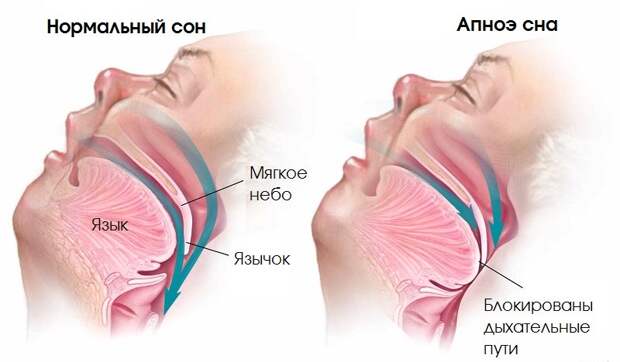 Апноэ сна - что это?