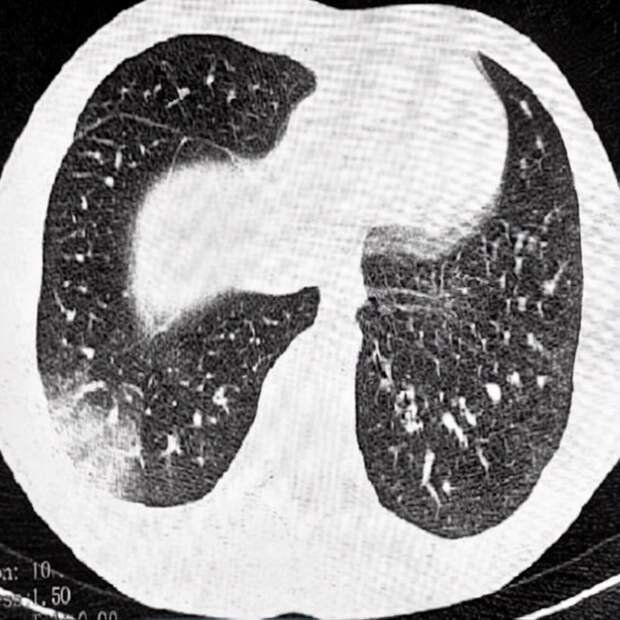 Троих подростков с «попкорновой» болезнью лёгких экстренно увезли в реанимацию в Ростовской области после курения вейпов.