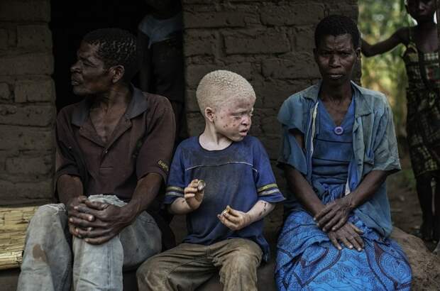 Жуткая реальность: в Африке людей-альбиносов убивают, чтобы сделать из них амулеты