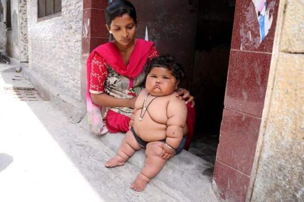 Индийская 8-месячная девочка страдает ожирением