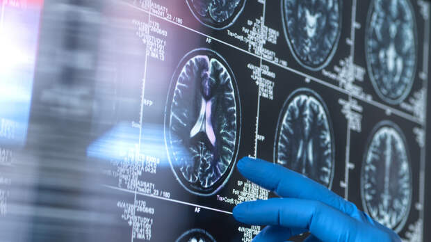 Диетолог Кованова рассказала о влиянии трансжиров на развитие деменции