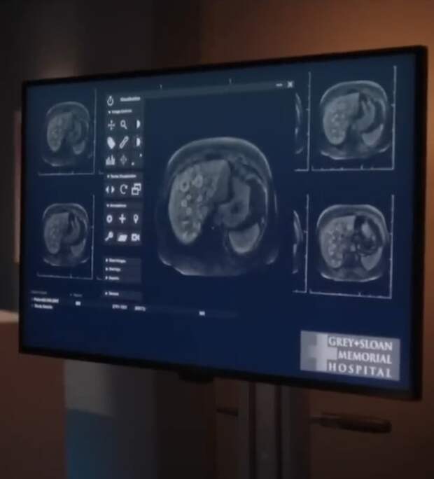 Catherine's scan shows many tumors on her liver.