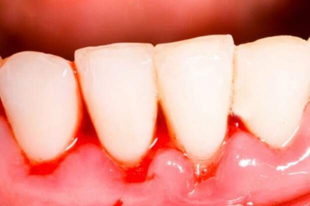 Природные средства для лечения заболеваний десен, о которых ваш стоматолог не говорит вам