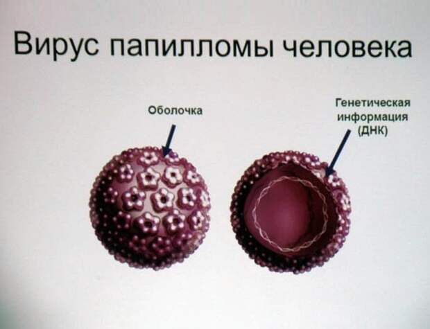 Почему растут папилломы? Виды папиллом и причины появления