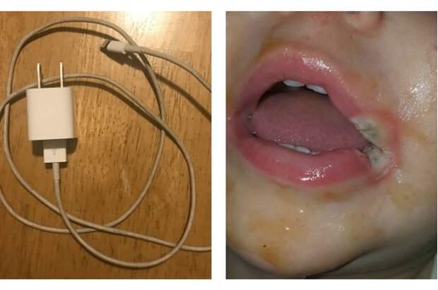 Ребёнок зacyнул зарядное устройство себе в рот и это превратилось в настоящий кошмар дети, зарядное устройство, кошмар, рот, устройство