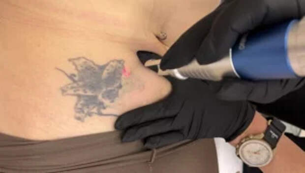 Процесс удаления татуировок без следов