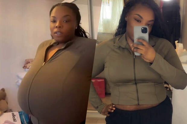 Британка с размером груди 40L сделала операцию по ее уменьшению