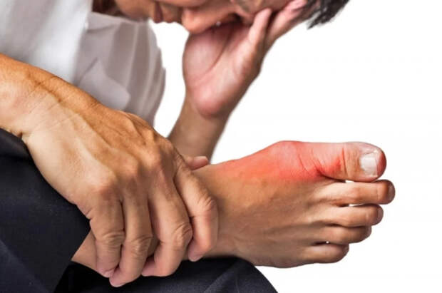 Ревматолог Самкова рассказала, как предотвратить появление подагры