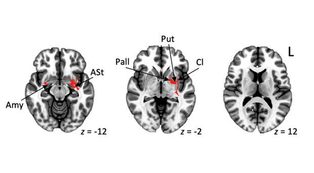 Была обнаружена общая мозговая сеть, которая вызывает заикание у людей разного возраста