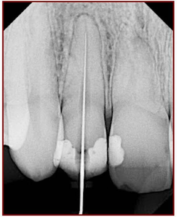 Как пломбируют корневые каналы в зубах как это сделано, пломба, зубы