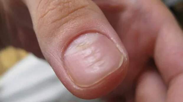 5 распространенных дефектов ногтевой пластины, которые часто ошибочно принимают за косметические