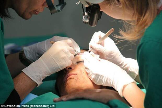 Операция представляет собой трансплантацию собственных волос пациента в область бровей врачи, жертвы насилия, кислота, кислотная атака, медицина, пластическая операция, трансплантация, фото