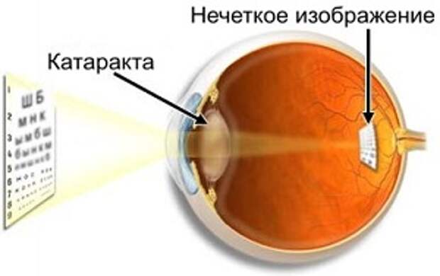 Как распознать катаракту? Как не пропустить начало развития катаракты, что должно настораживать?