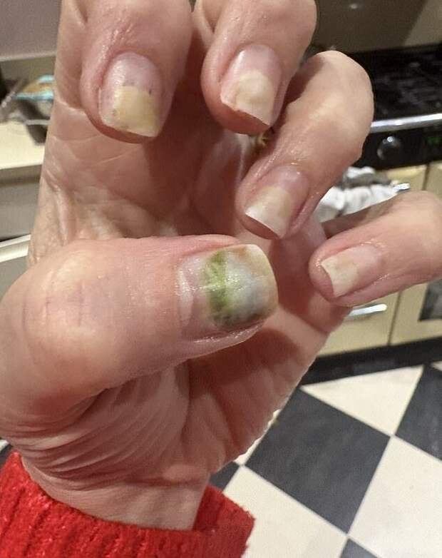 Daily Mail: ноготь британки позеленел и отслоился после маникюра