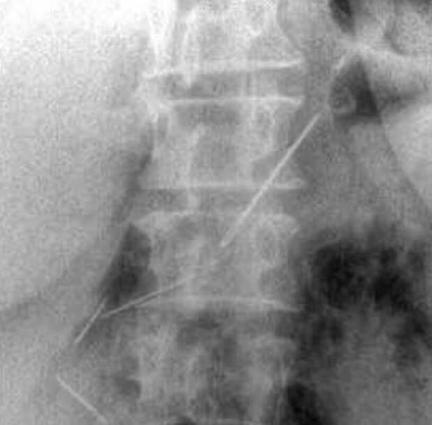 В Подмосковье пенсионерка наглоталась швейных игл