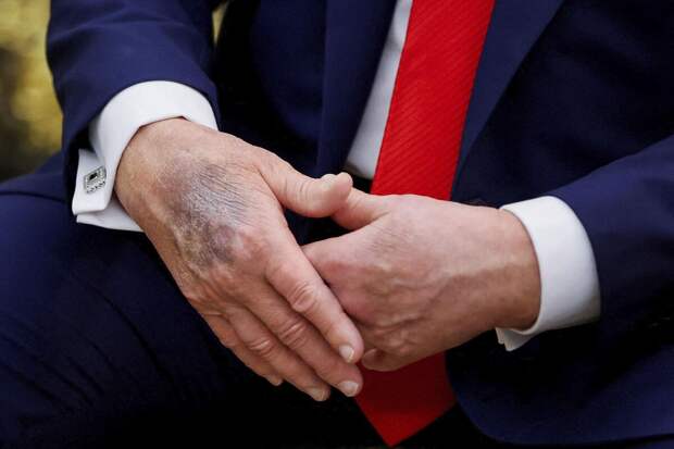 Трамп признался в чрезмерном употреблении аспирина для разжижения крови