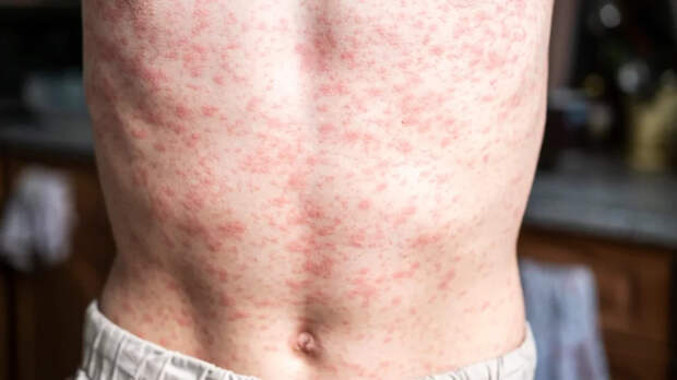 Sunday Times: в Лондоне более 60 детей заболели корью из-за отказа от прививок