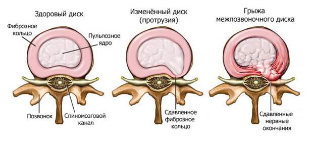 как лечить грыжу позвоночника народными средствами