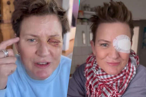 «Я чуть не умерла от боли»: Андреа Плевиг лишилась глаза из-за фейерверка, едва победив рак