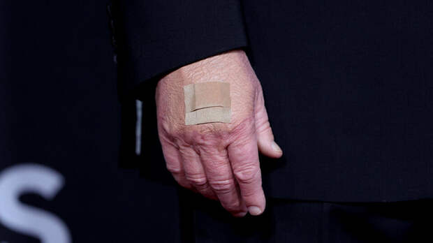 Трамп назвал причину появления синяков на его руках