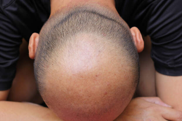 Врач Шацкая: при облысении помогут мезотерапия и плазмотерапия