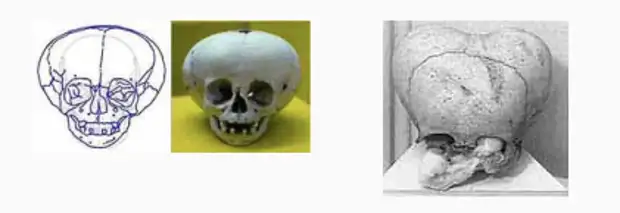 Жестокие эксперименты: в чём может быть причина деформации головы в древности