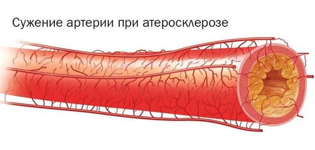 Атеросклероз поражает все артерии, поэтому необходимо исследовать все сосуды Атеросклероз поражает все артерии, поэтому необходимо исследовать все сосуды