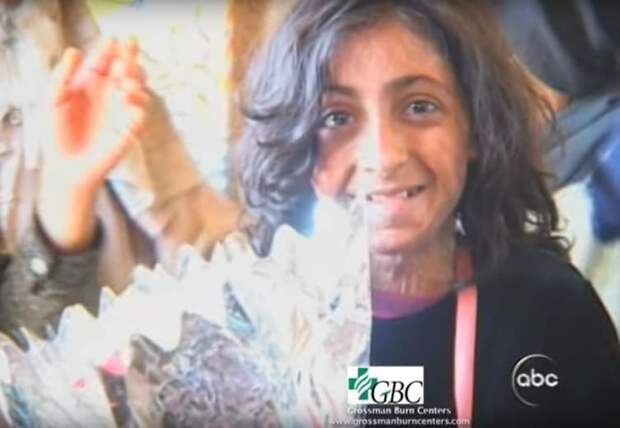 Послу успешной реабилитации девочка вернулась в Афганистан девочка, лицо, операция, пожар