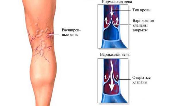 Варикозное расширение вен: эффективные рецепты народной медицины